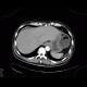 Ischemia of large bowel: CT - Computed tomography